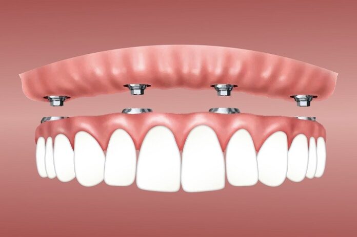 Dental Implants