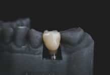 Care for Your Implant