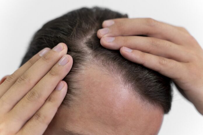 Male Pattern Baldness