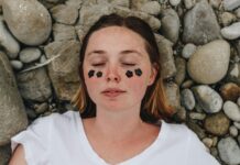 Acne Scarring Prevention