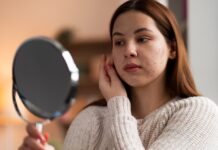 Persistent Skin Congestion